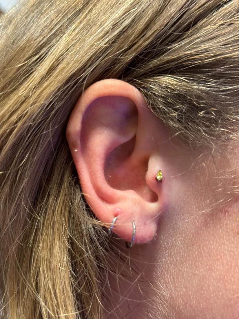Tragus piercing with a gold teardrop gem, healed